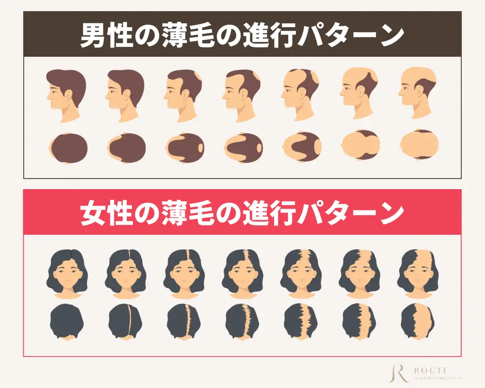 男性の薄毛の進行パターン