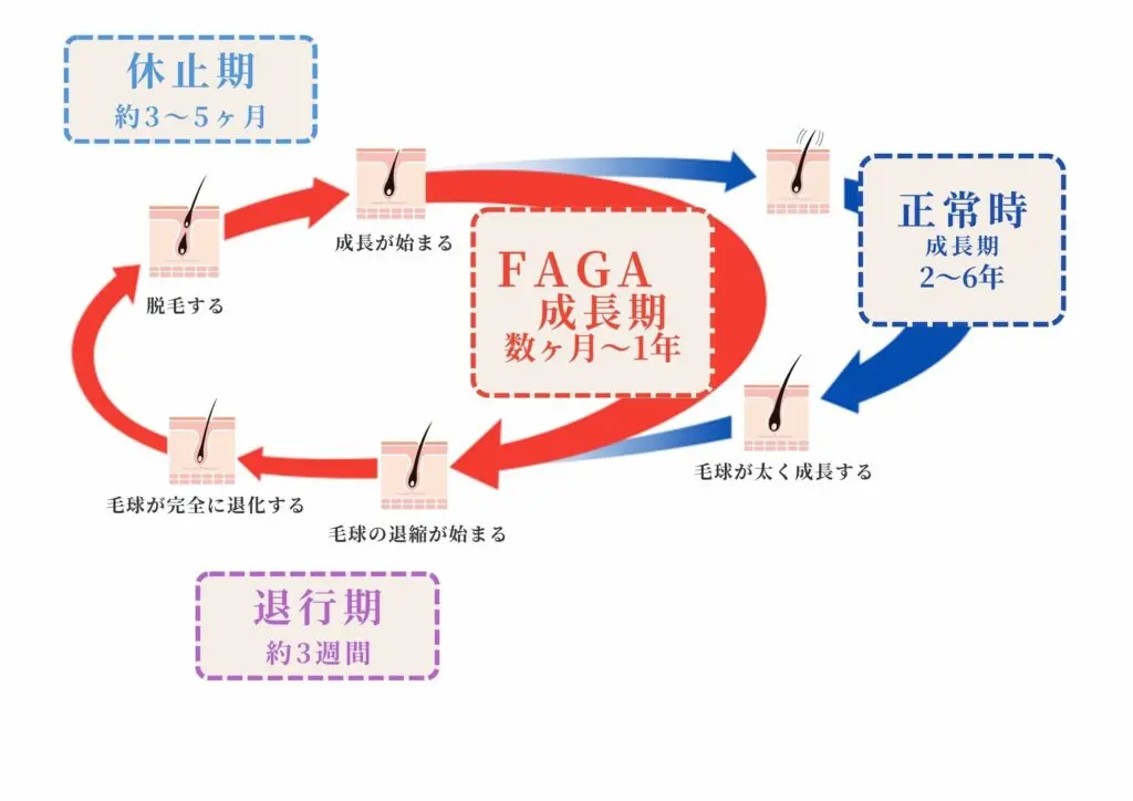 FAGAを発症した際の毛周期